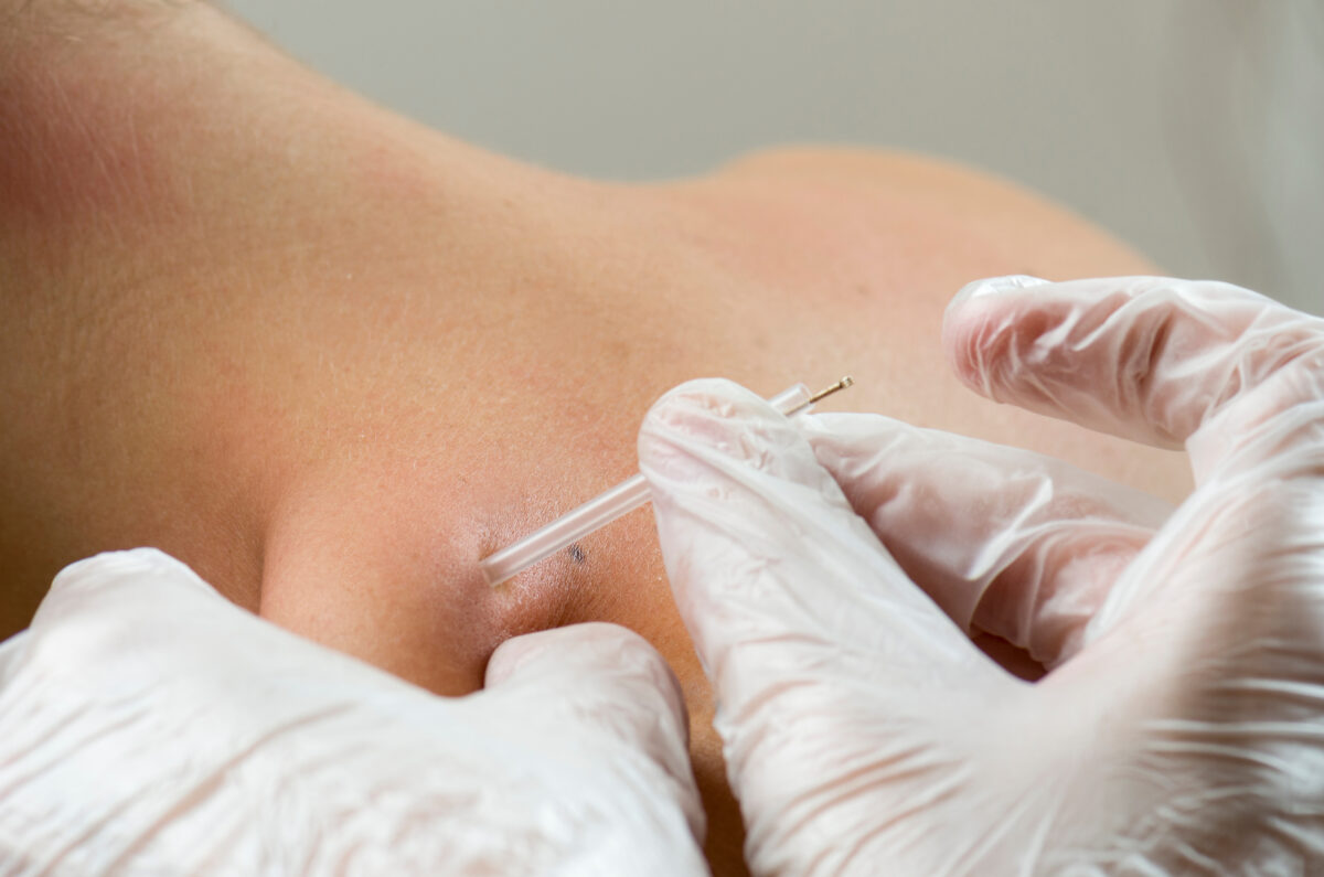 Martens Chiropractic - Dry Needling